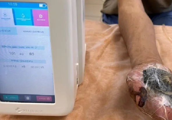 В хирургическом отделении № 4 Центральной городской клинической больницы активно используются передовые технологии для лечения ран